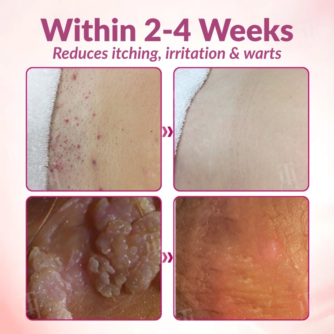 Piguiay® Femina HPV Relief Gel