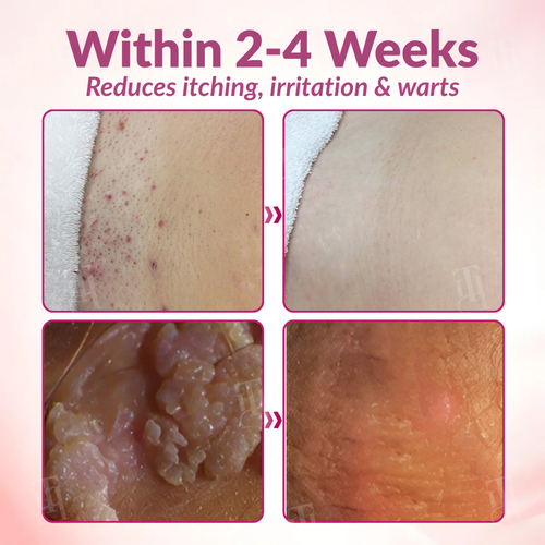 Piguiay® Femina HPV Relief Gel